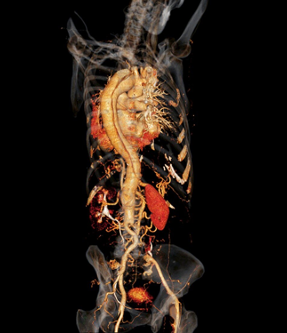 Aortic aneurysm CT scan