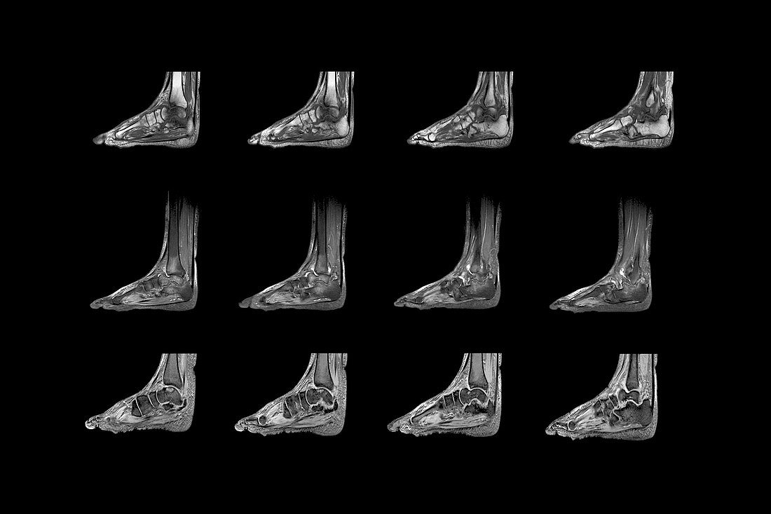 Charcot arthropathy,MRI scans