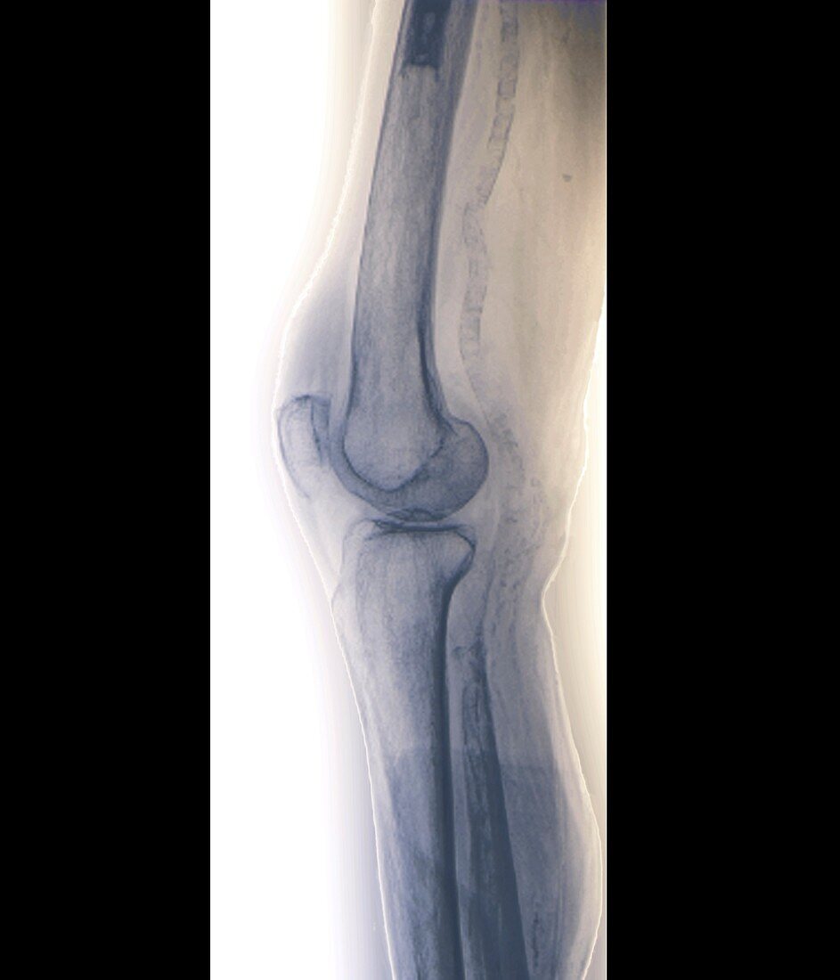 Arteritis of the knee,X-ray