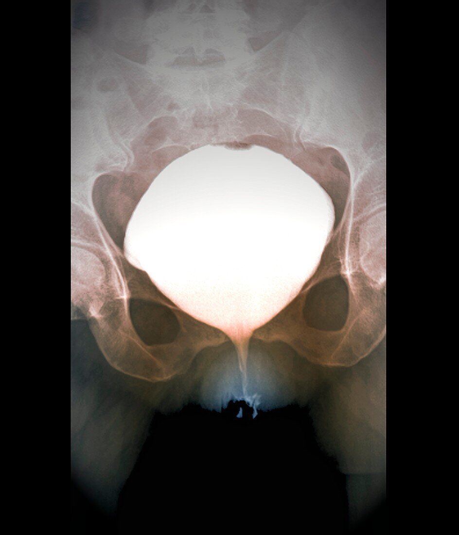 Full bladder,X-ray cystography
