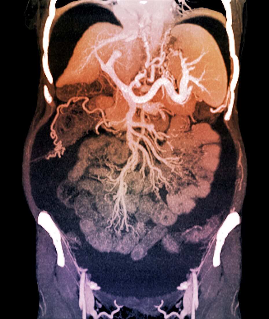 Chronic liver disease,CT scan