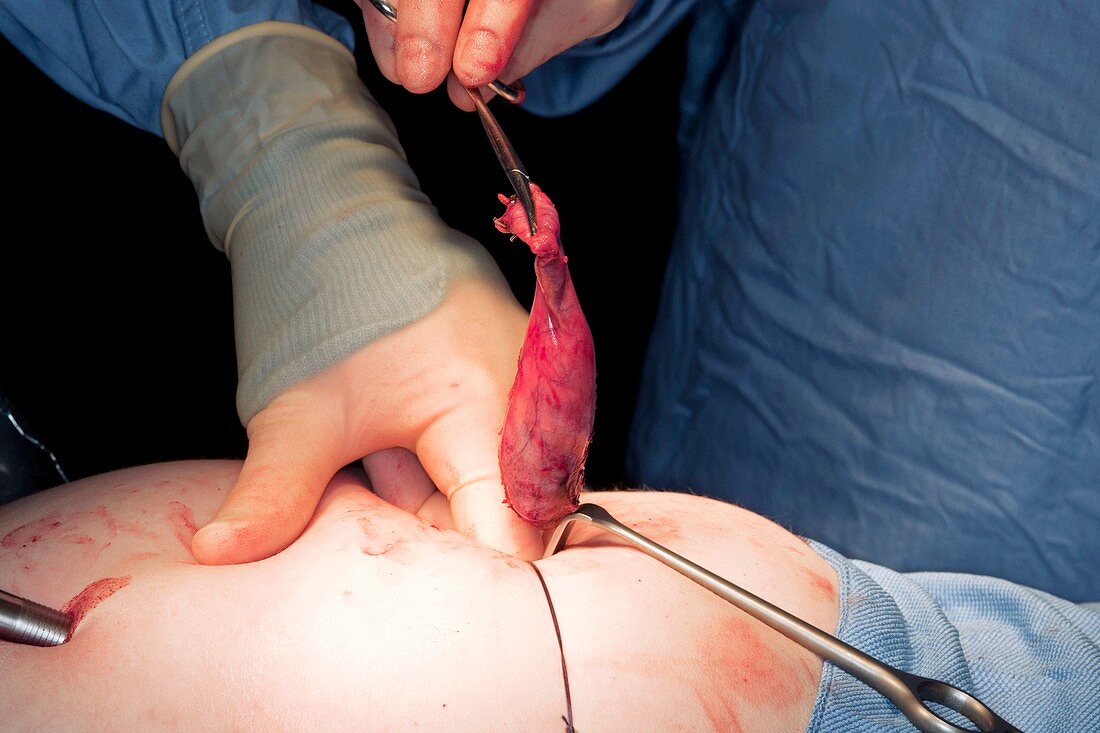 Gallbladder removal surgery