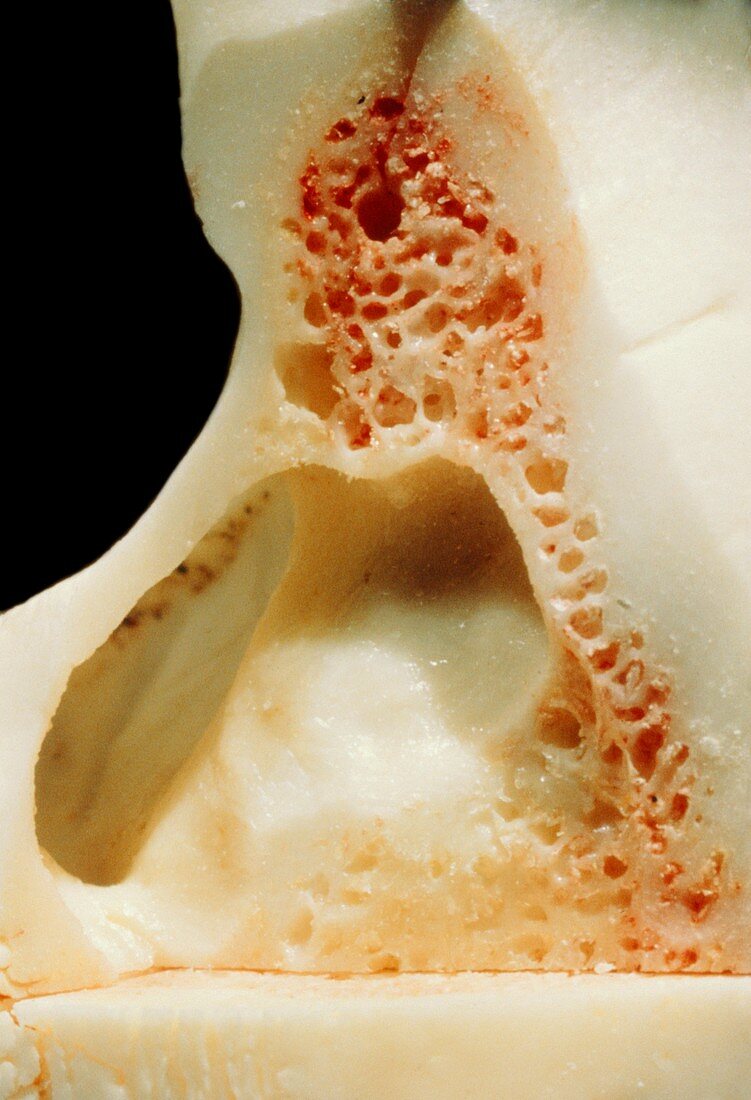 Frontal sinus,anatomical dissection