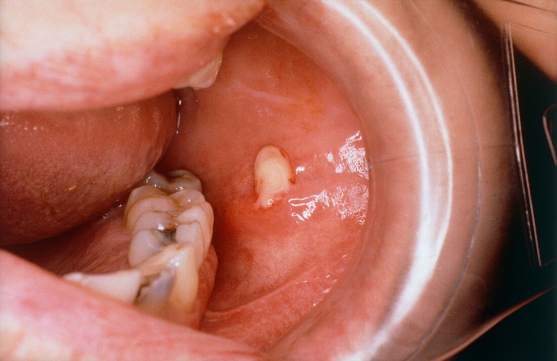 Infected salivary gland