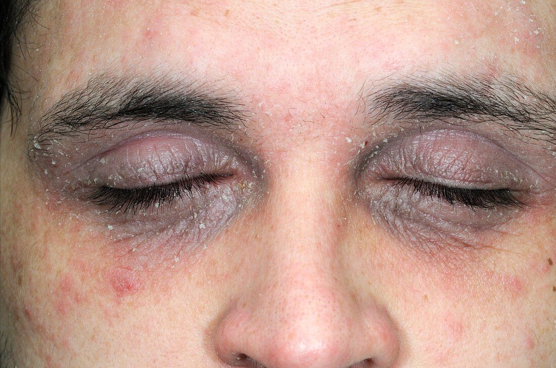Eczema around the eyes