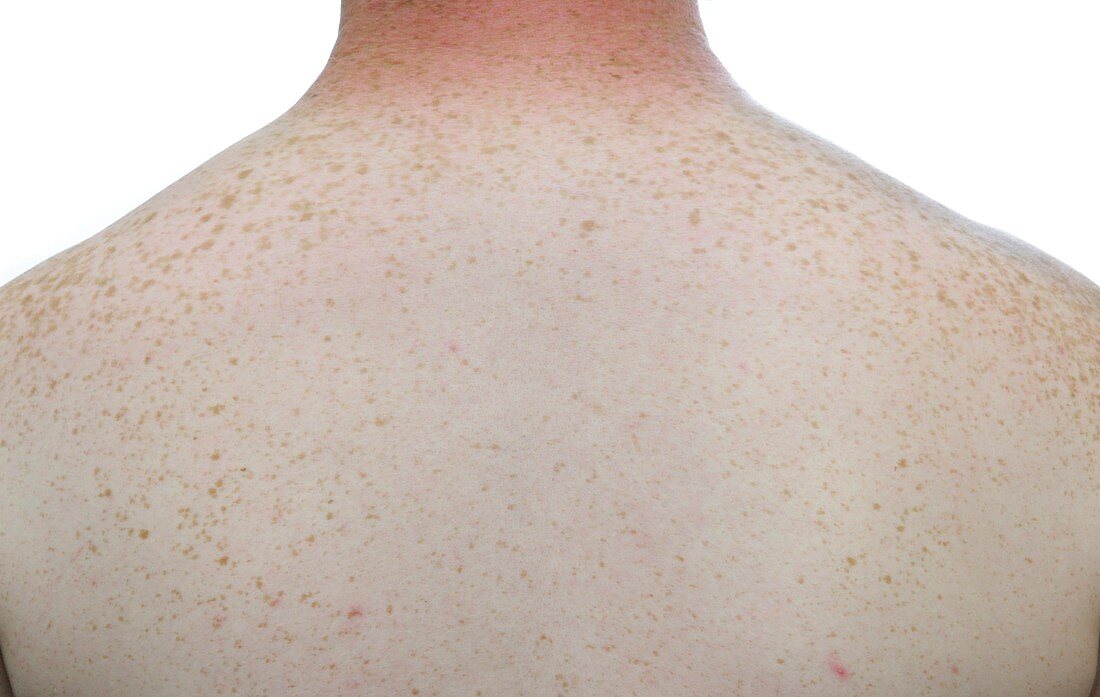 Freckles on the skin of the back