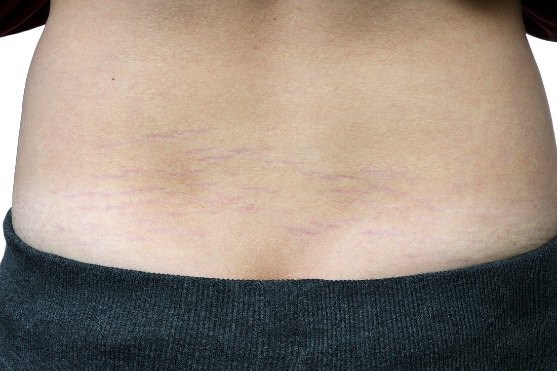 Striae growth marks on the skin