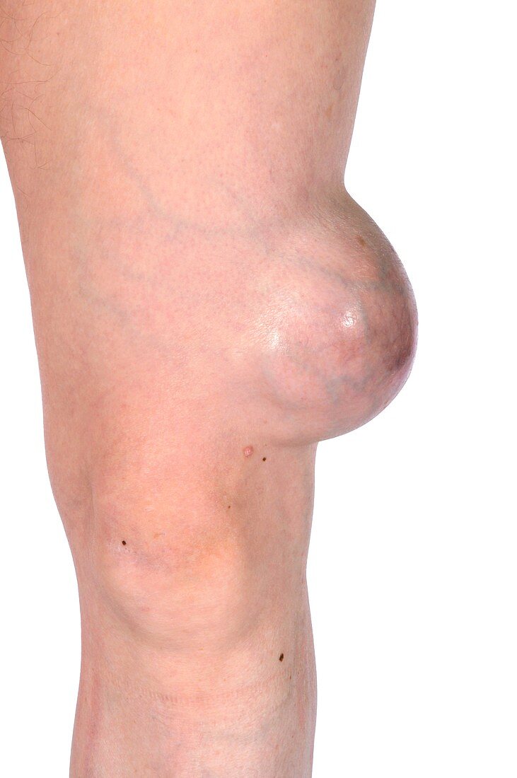 Cancer of the knee