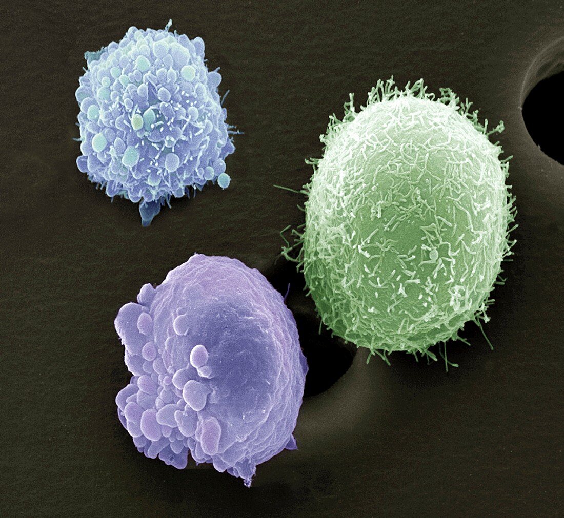 Skin cancer cells,SEM