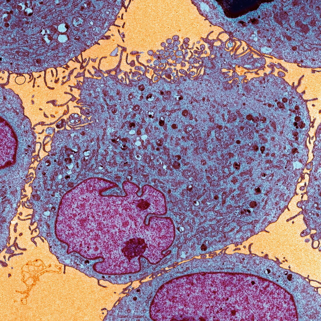 Leukaemia cells,TEM