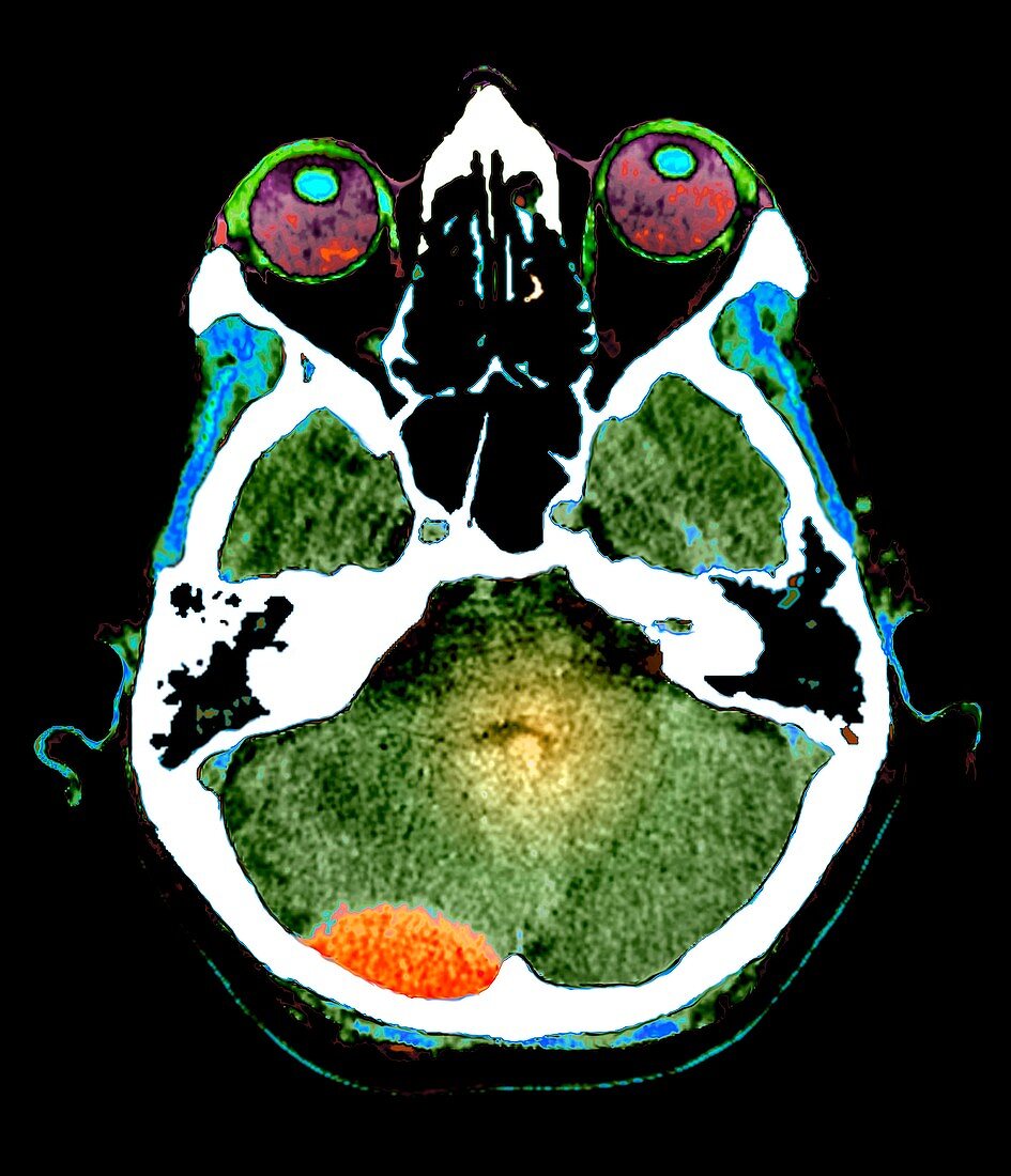 Extradural haematoma,CT scan