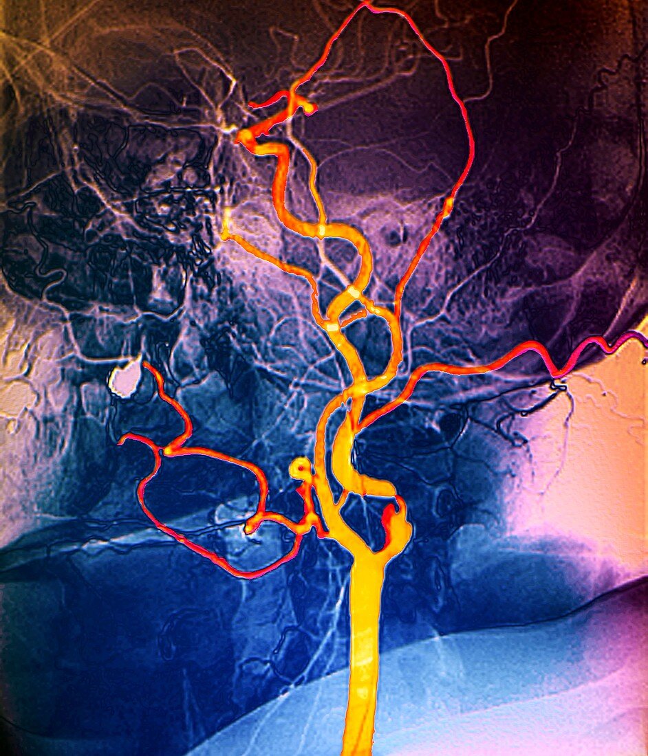 Narrowed neck artery,angiogram