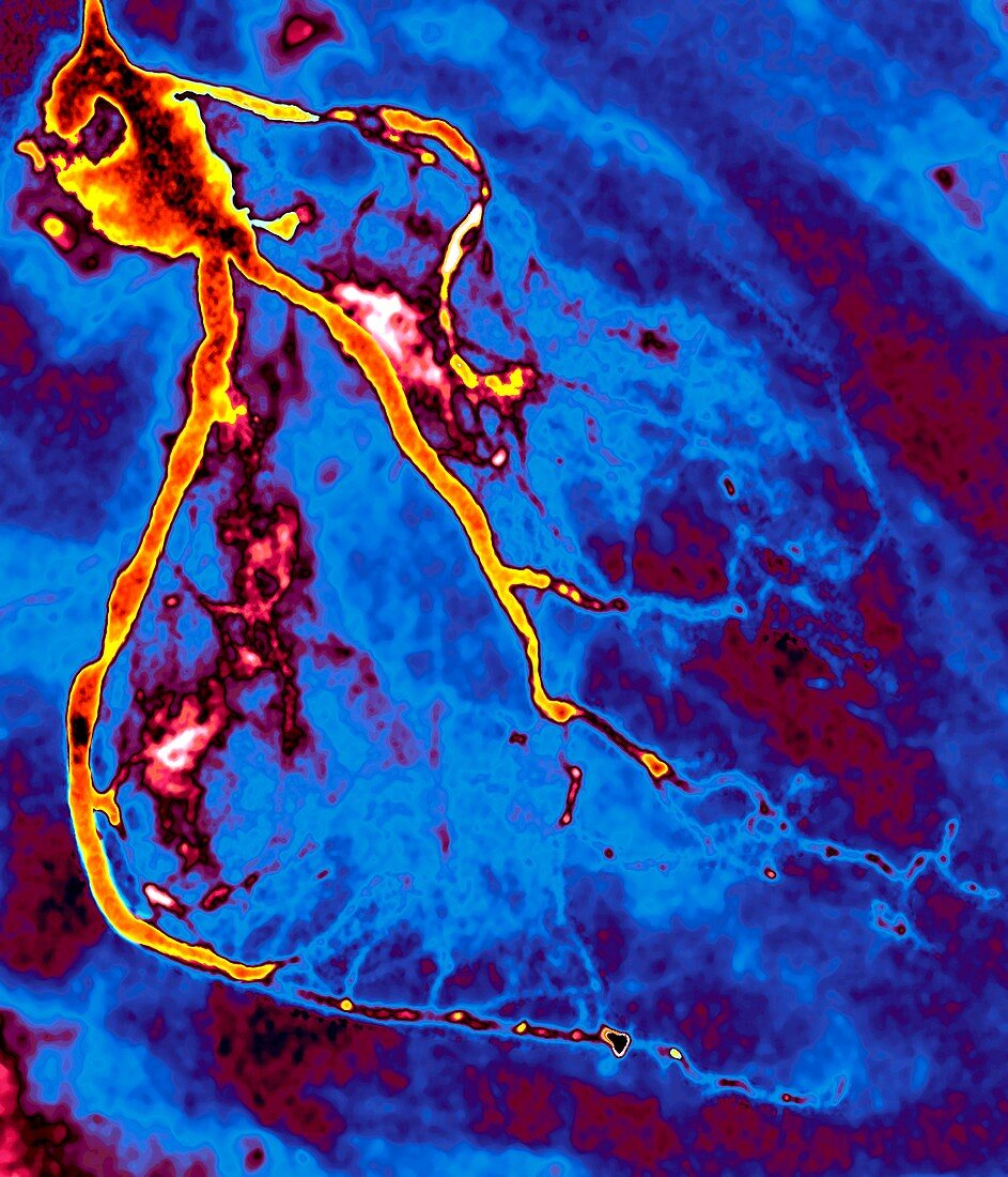 Narrowed coronary arteries,X-ray