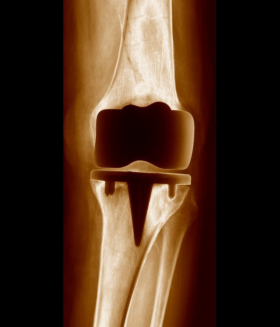 Prosthetic knee joint,X-ray