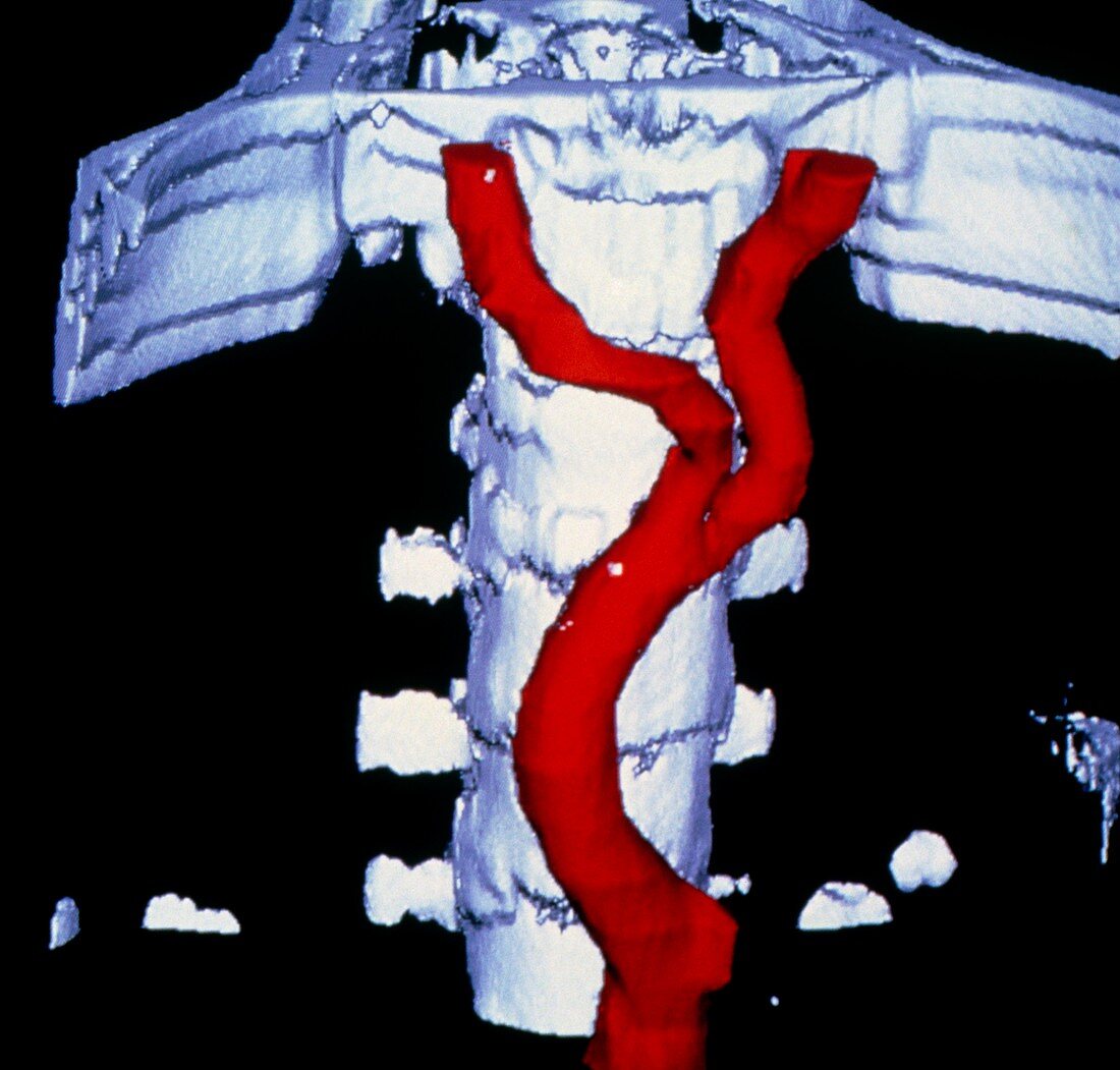 False-colour 3-D CT image of abdominal aorta