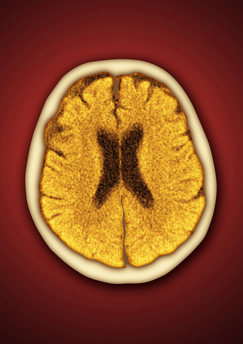 Healthy brain,CT scan