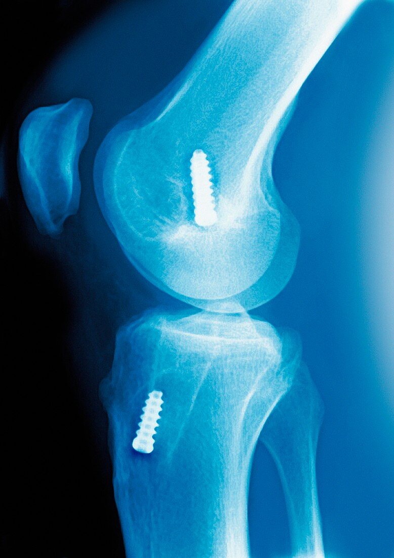 Anterior cruciate ligament repair,X-ray