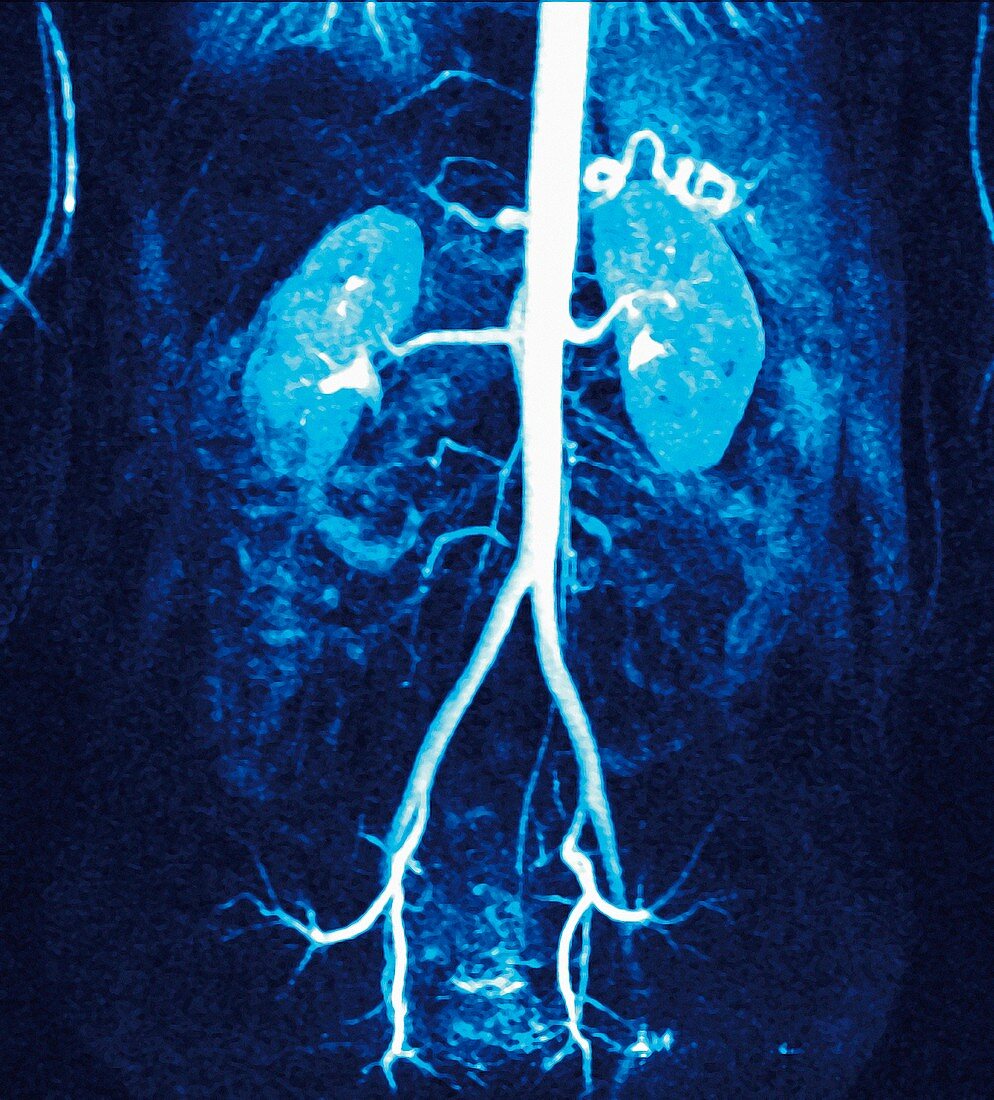Normal renal arteries,MRA scan