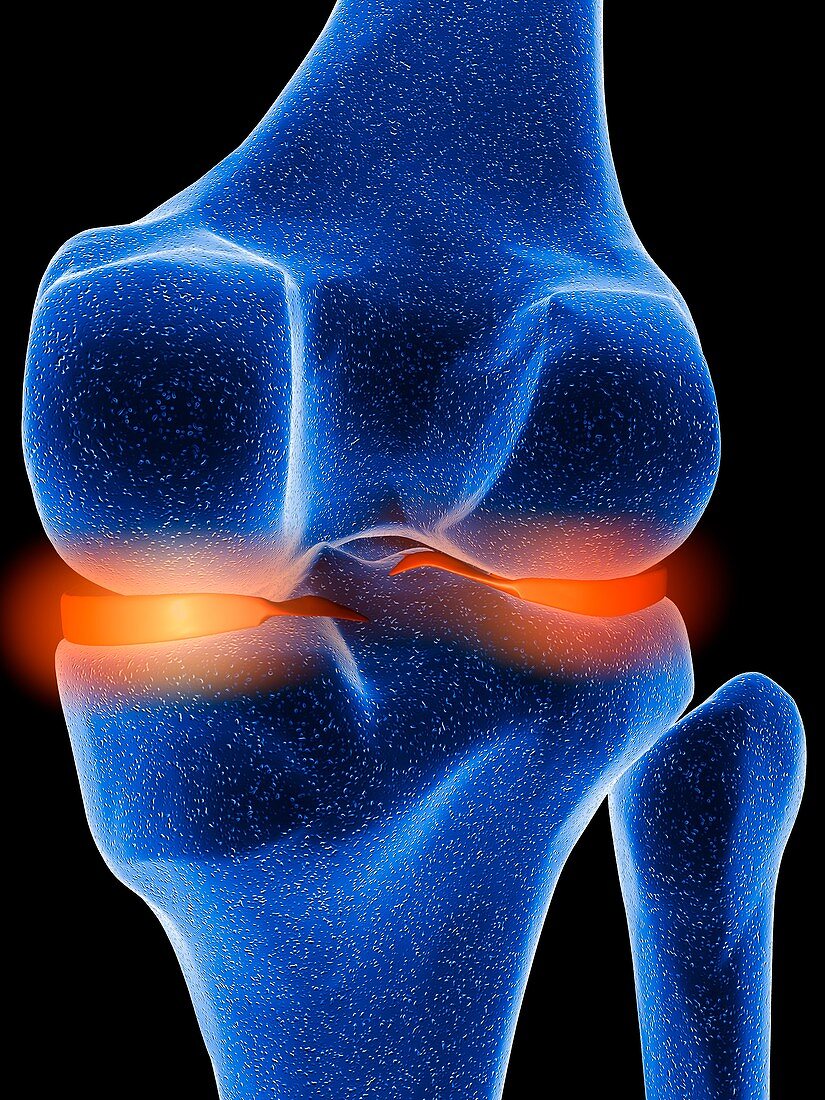 Inflamed knee cartilage,computer artwork