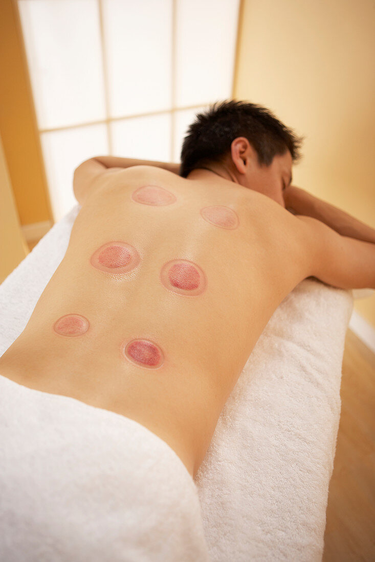 Cupping