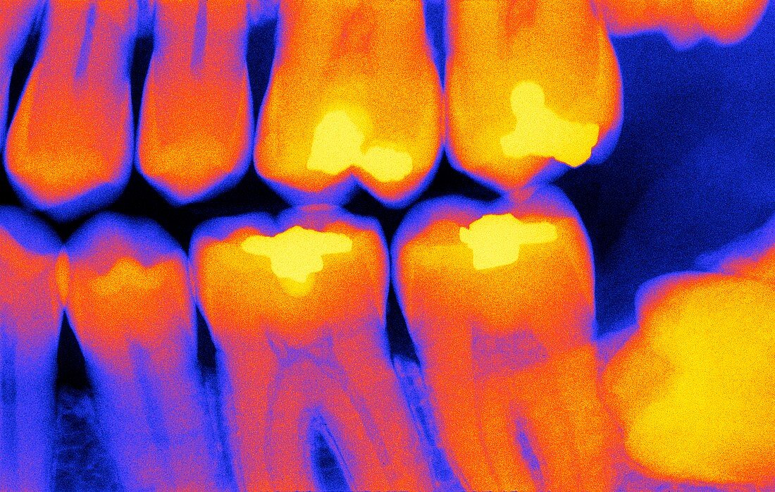 Teeth with fillings,X-ray