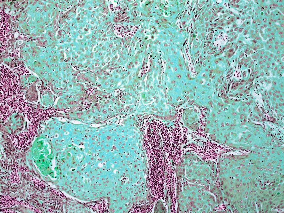 Tongue cancer,light micrograph