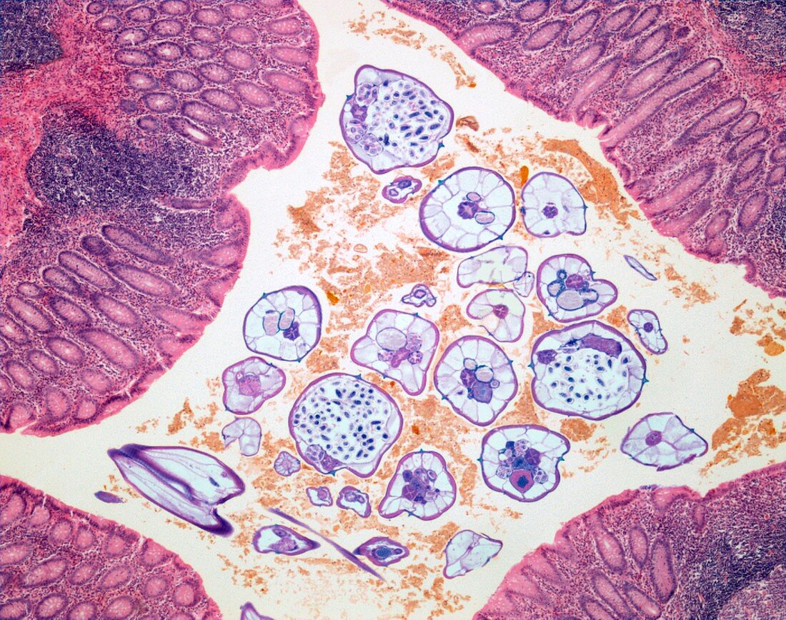 Nematode infection,light micrograph