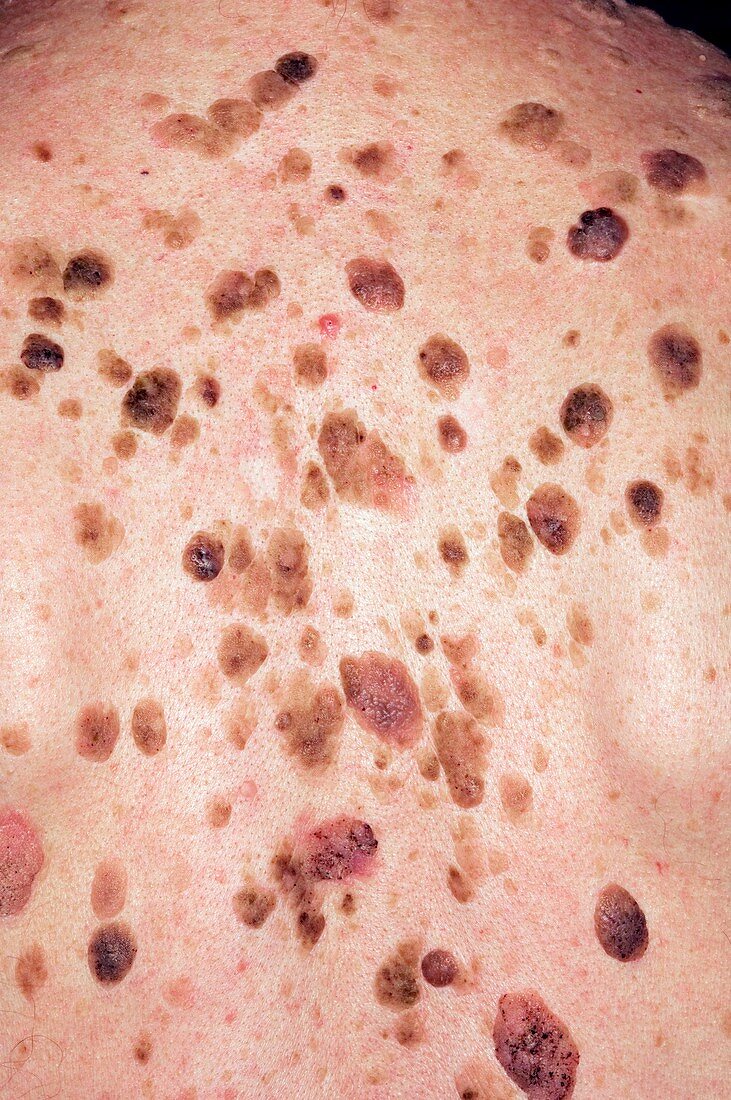 Seborrhoeic warts