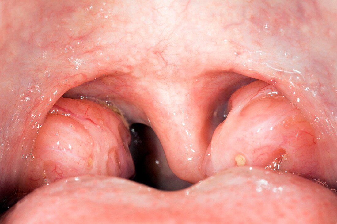 Enlarged tonsils