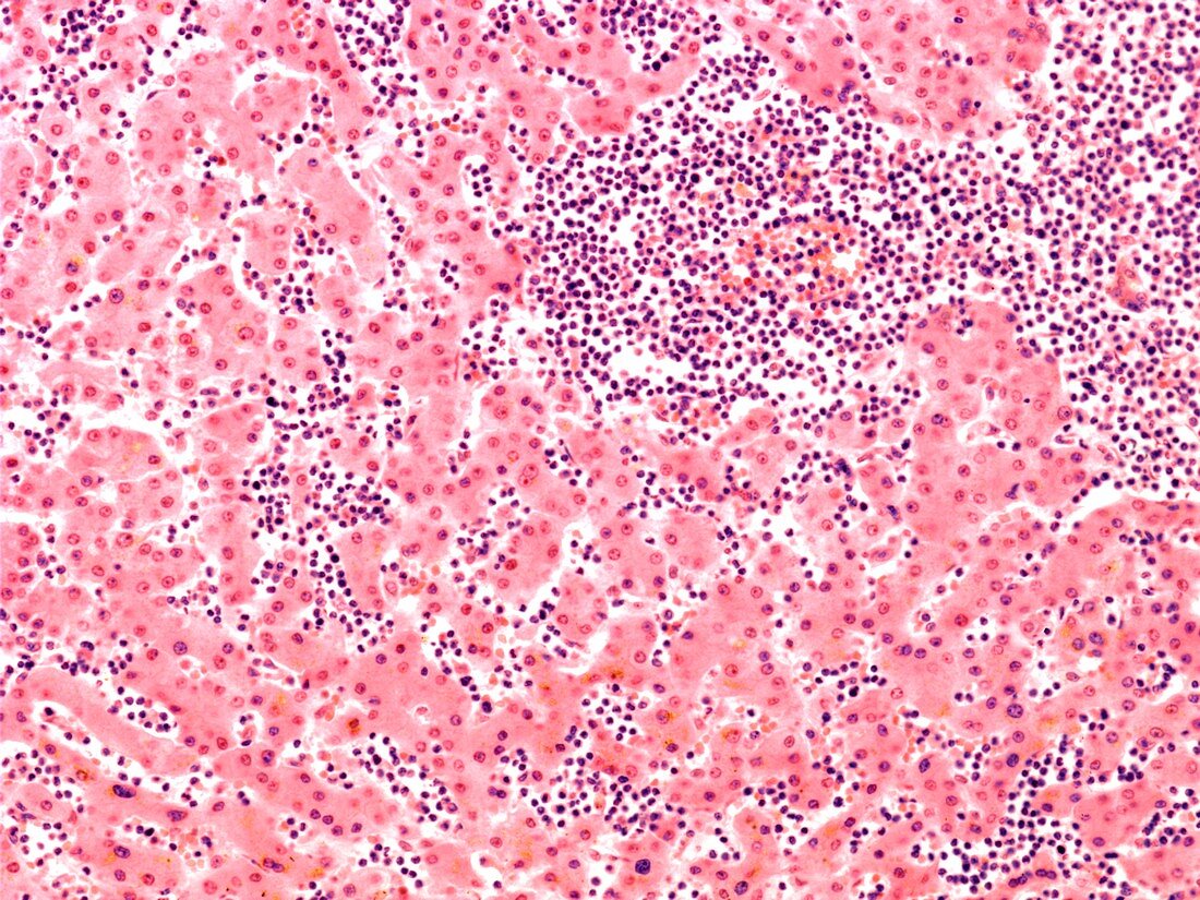 Leukaemia blood cells,light micrograph