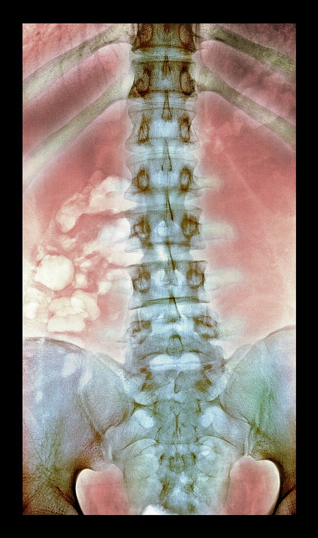Normal spine,X-ray