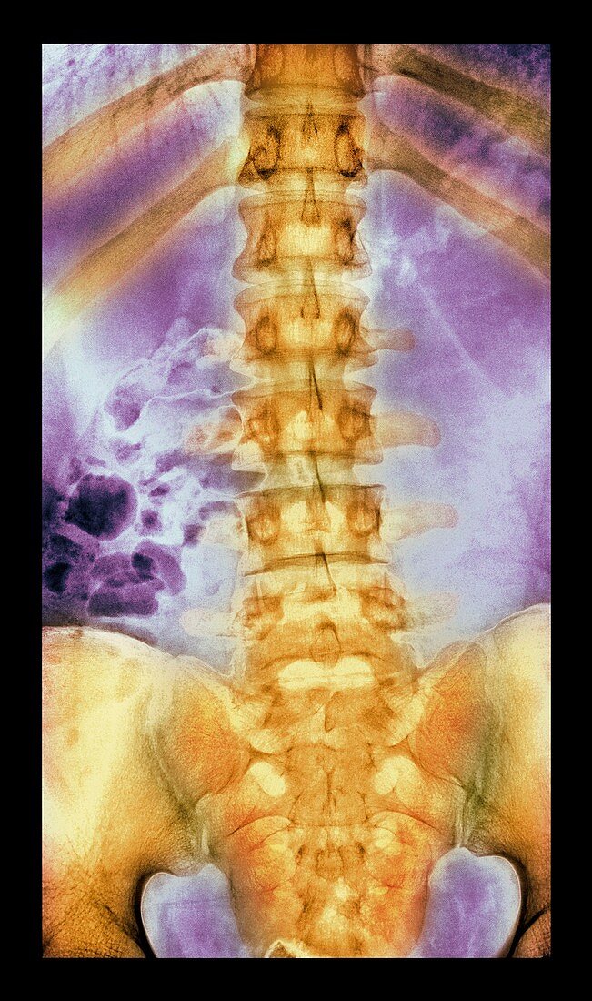 Normal spine,X-ray