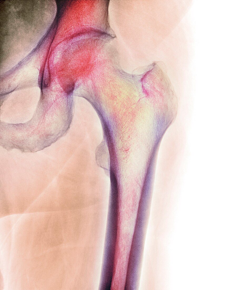 Normal hip,X-ray