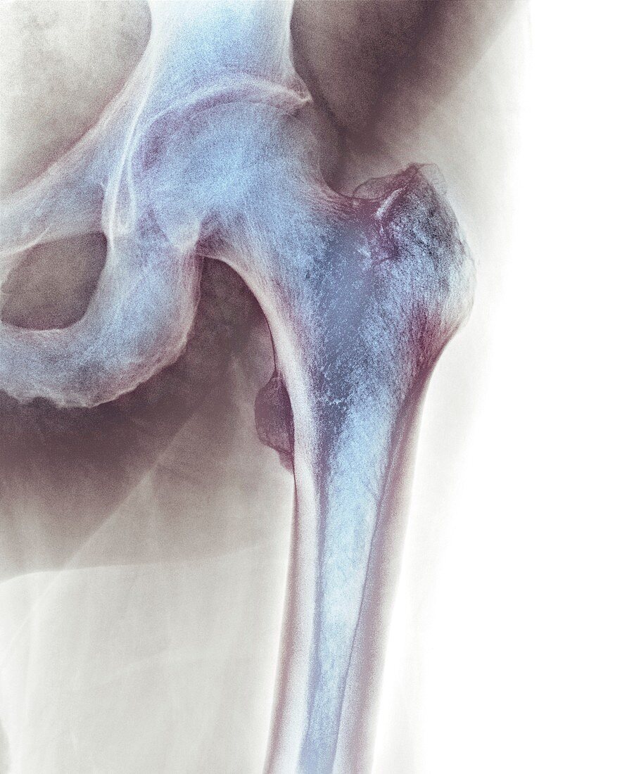 Normal hip,X-ray