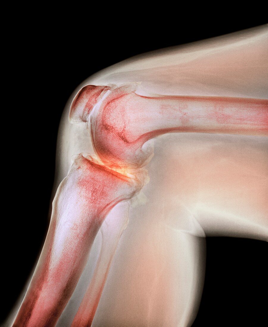 Arthritis of the knee,X-ray