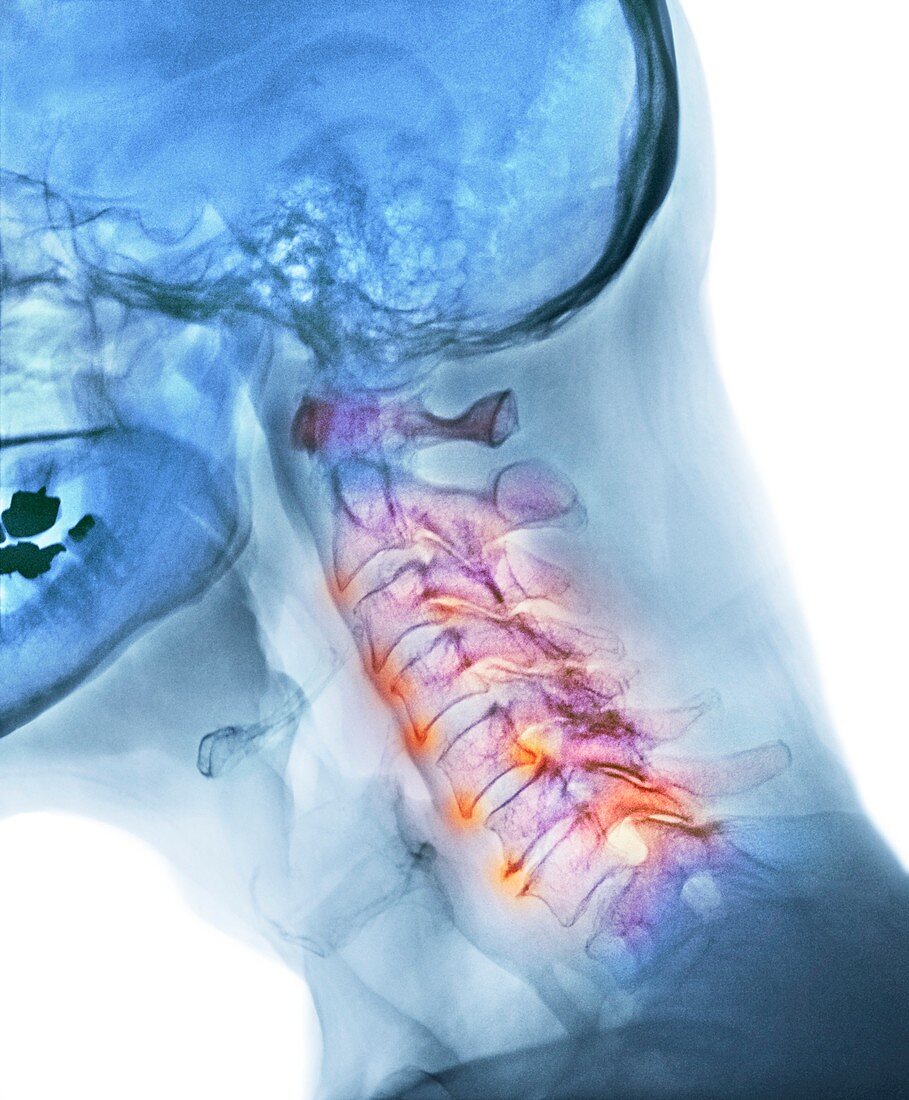 Arthritis of the neck,X-ray