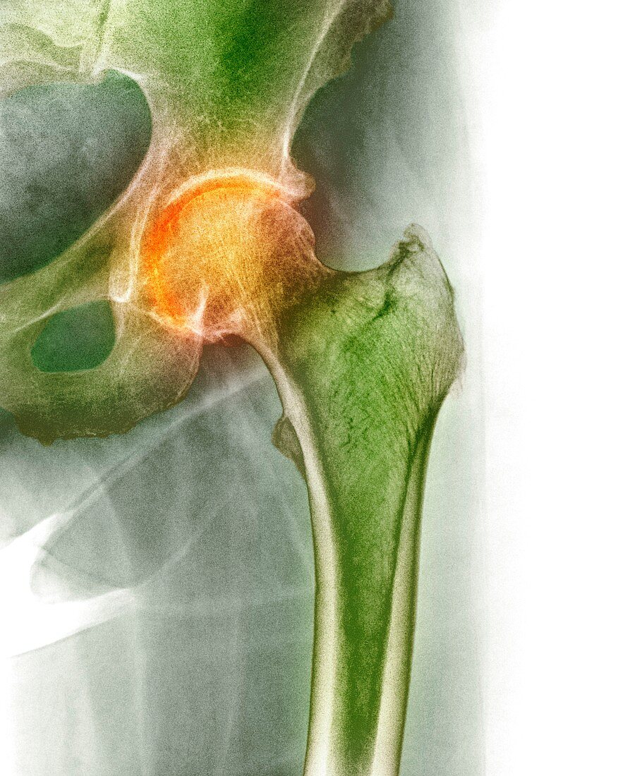 Arthritis of the hip,X-ray