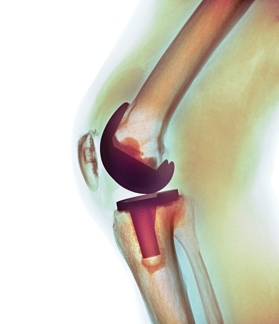 Knee replacement,X-ray