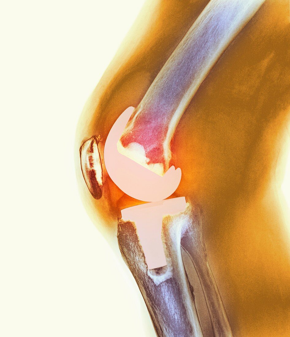 Knee replacement,X-ray