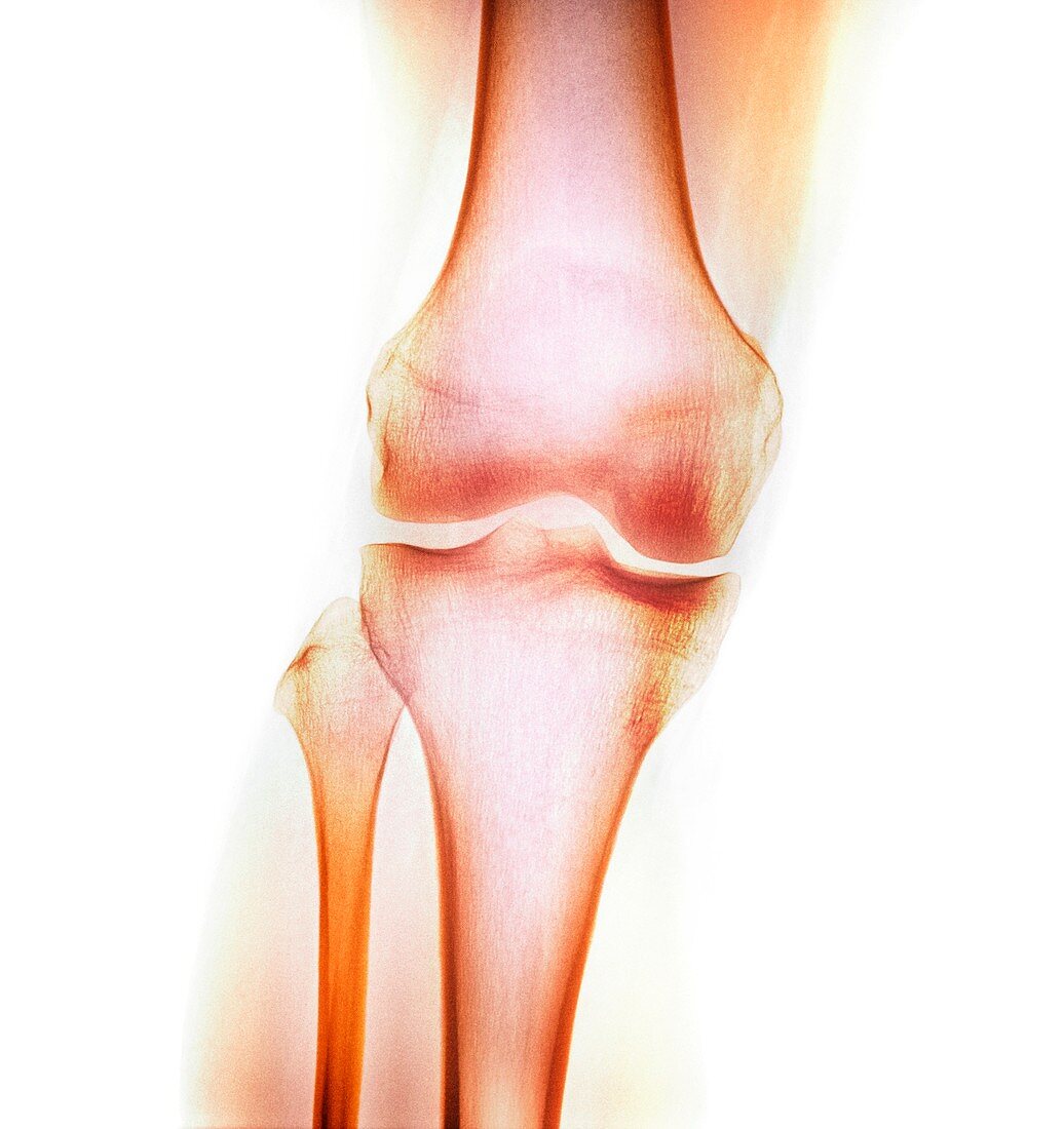 Normal knee,X-ray