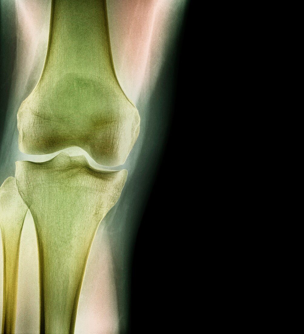 Normal knee,X-ray