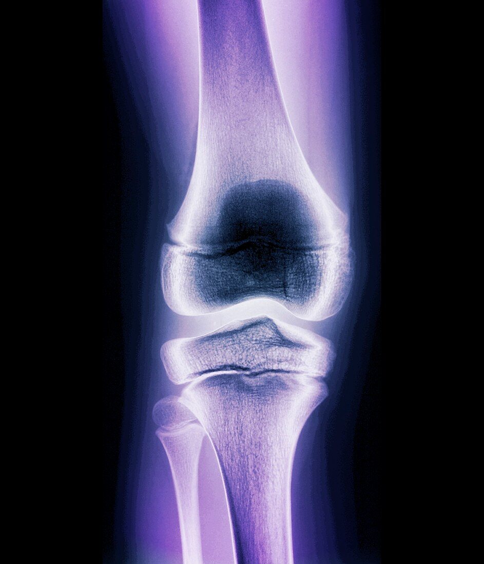 Normal child's knee,X-ray