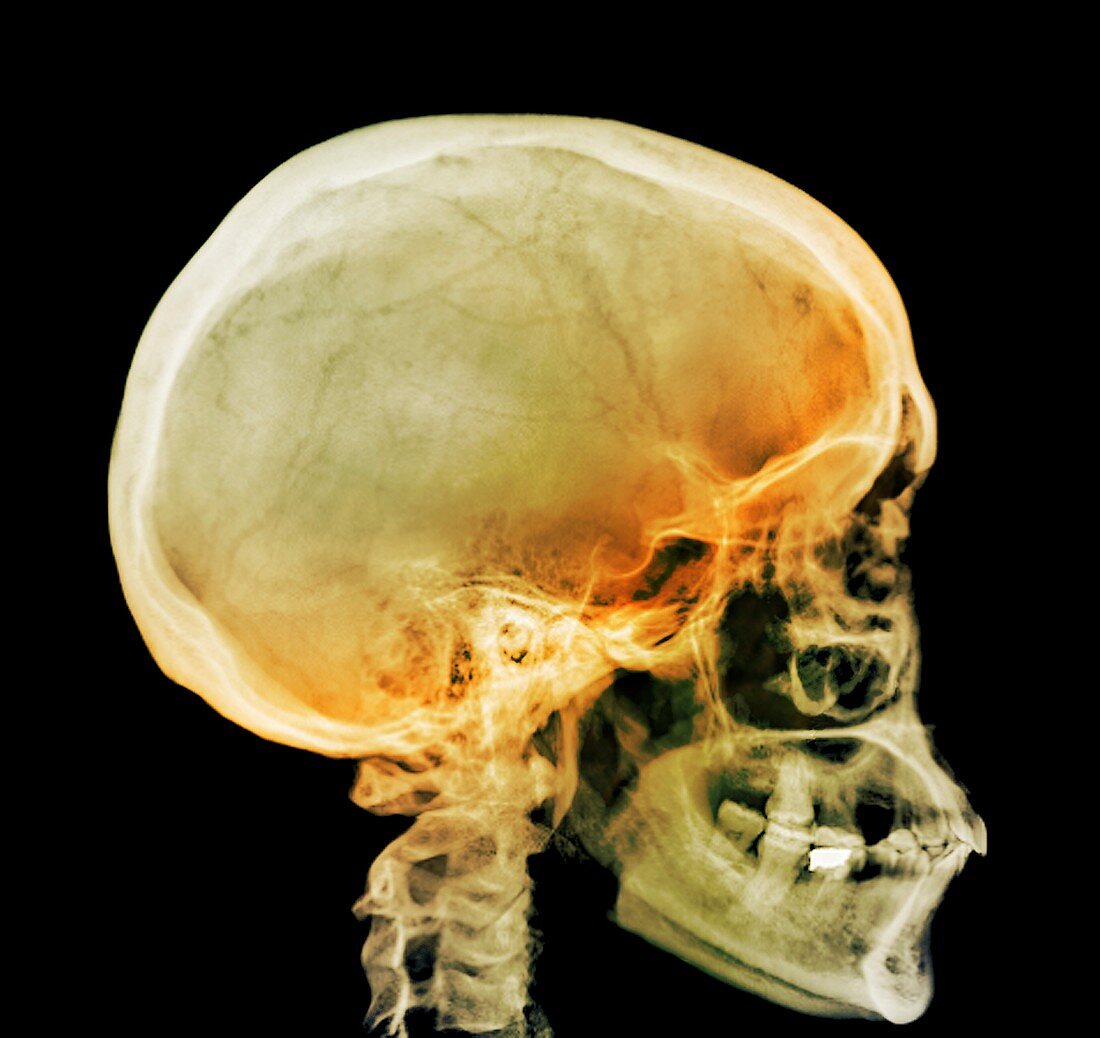 Normal skull,X-ray