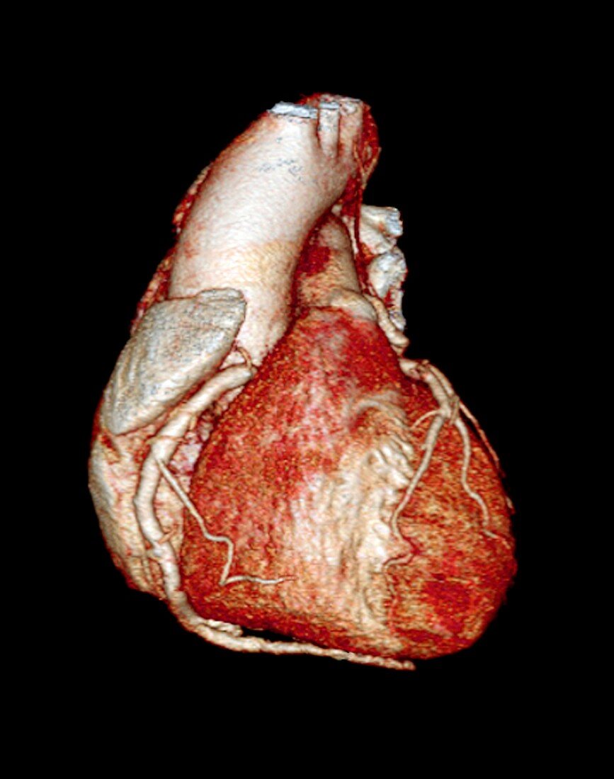 Normal heart,3D CT scan