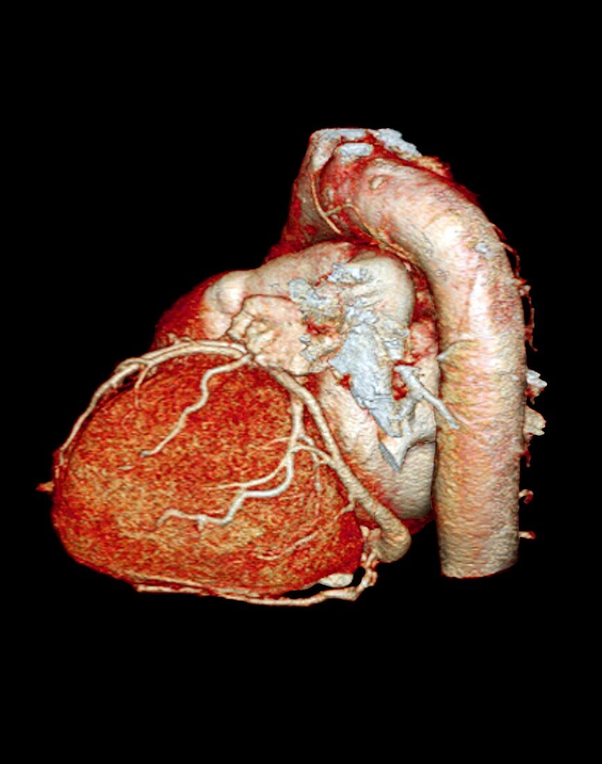 Normal heart,3D CT scan