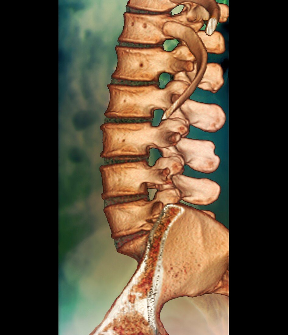 Normal spine,CT scan