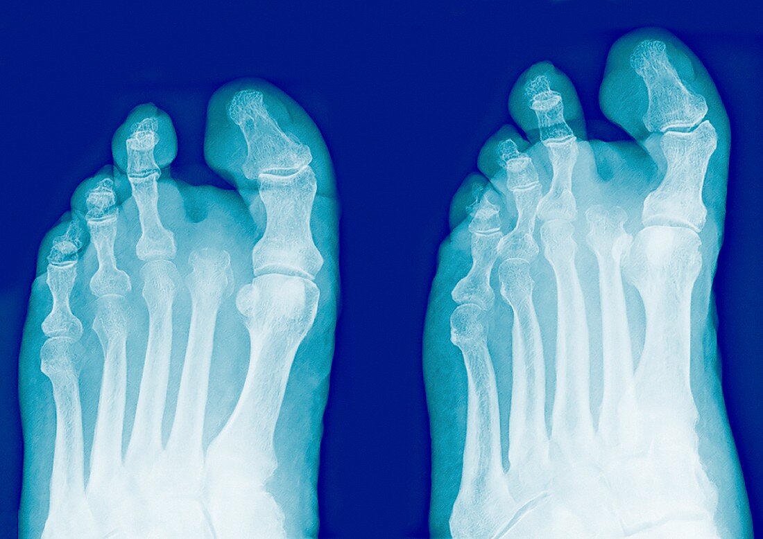 Amputated toe,X-rays