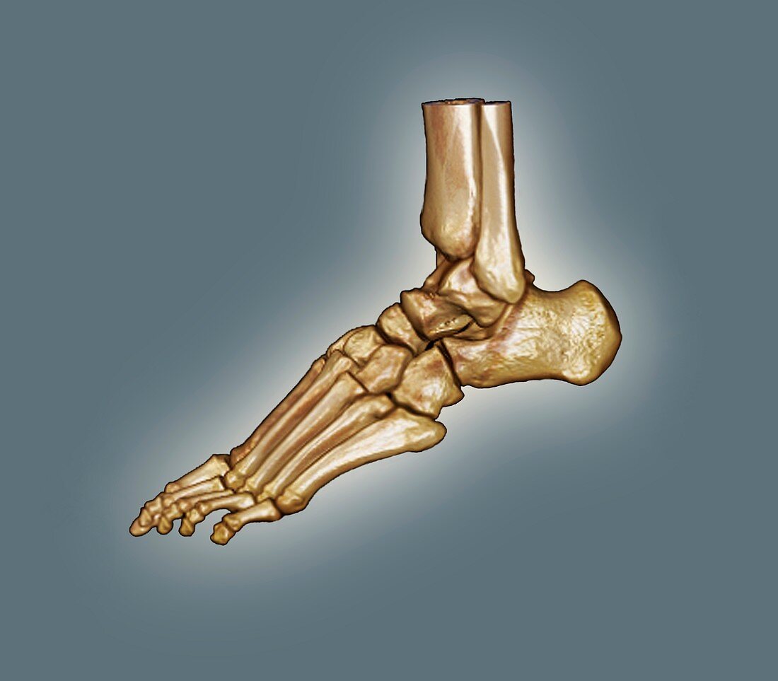 Normal foot,3D CT scan