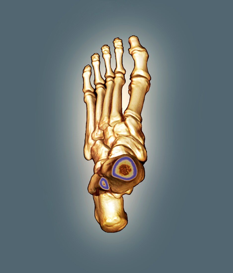 Normal foot,3D CT scan