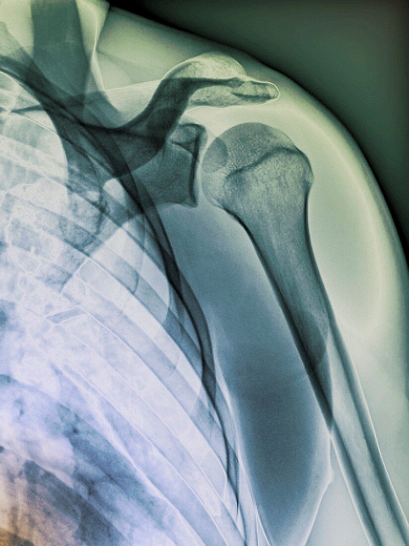 Normal shoulder,X-ray
